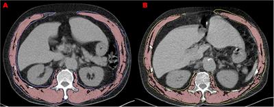 Accelerated loss of trunk muscle density and size at L1 vertebral level in male patients with COPD